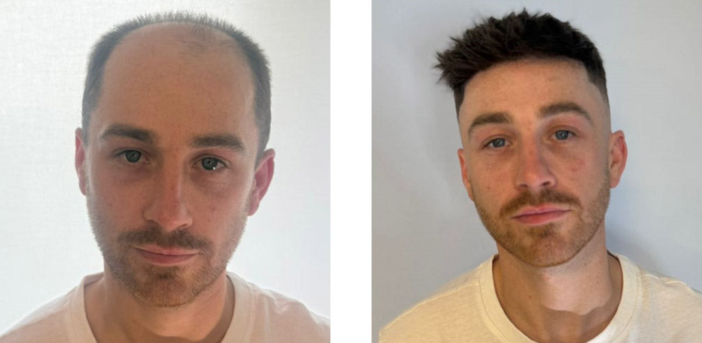 How Much is Hair System Maintenance: The True Price Guide for You